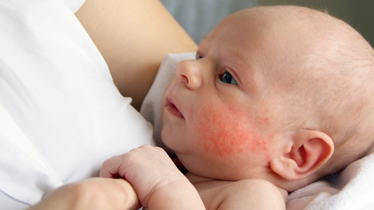 5 Common Causes of Baby Rashes and How to Avoid Them